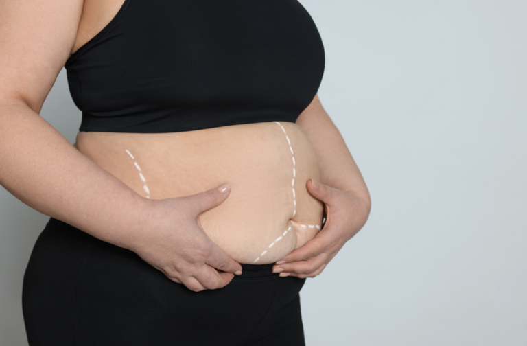 Cirurgia Bariátrica Pelo Bradesco Saúde Cobertura Essencial